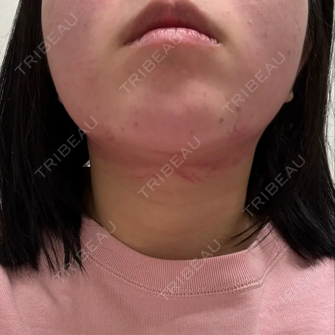 ボトックス（エラ・小顔） / その他（輪郭） ルラ美容クリニック 名古屋栄院 / ルラスキンクリニック 名古屋栄院 DAY 1 メイン用