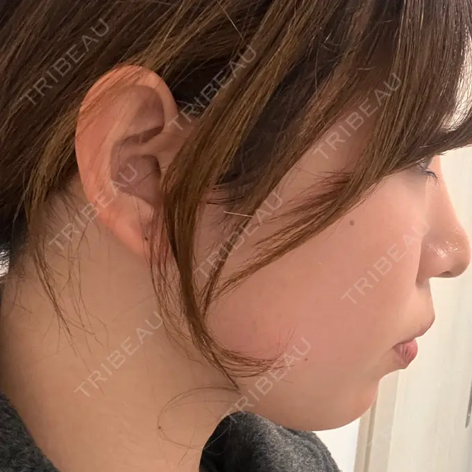 ボトックス（あご） / ボトックス（エラ・小顔） TCB東京中央美容外科 名古屋栄院 DAY 0 メイン用