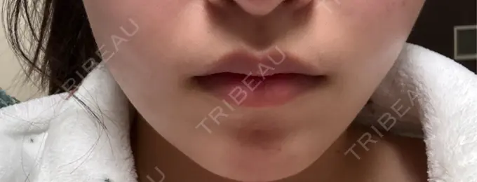 ボトックス（エラ・小顔） 共立美容外科 千葉院 AFTER メイン用