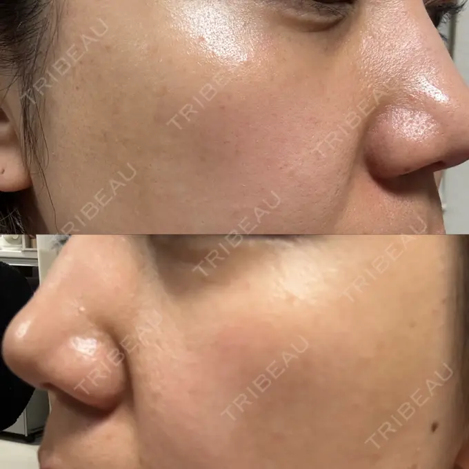 ポテンツァ ルラ美容クリニック 高田馬場院 DAY 11 メイン用