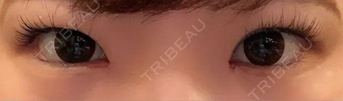 目頭切開 もとび美容外科クリニック 新宿院 DAY 5 メイン用