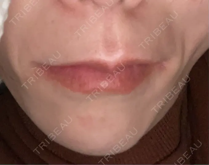 ボトックス（あご） TCB東京中央美容外科 神戸院 DAY 9 メイン用