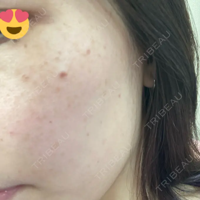 光治療（フォトフェイシャルなど） ルラ美容クリニック 広島院 AFTER メイン用