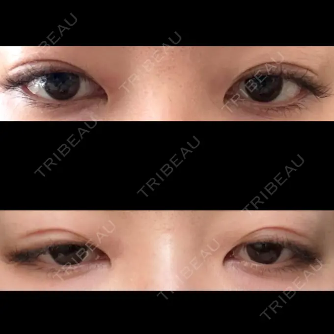 二重埋没 水の森美容クリニック 東京銀座院 DAY 28 メイン用