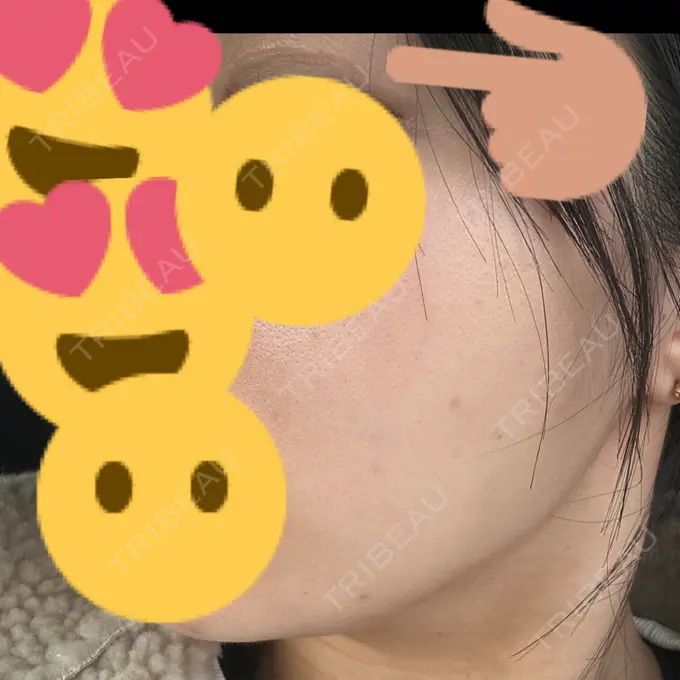 糸リフト / 脂肪吸引（顔） / 脂肪吸引（二の腕） / 上まぶたたるみ取り / 上まぶたの脂肪取り / ジョールファット除去 / 脂肪吸引（肩） / ボトックス（エラ・小顔） 湘南美容クリニック 秋葉原院 DAY 272 メイン用