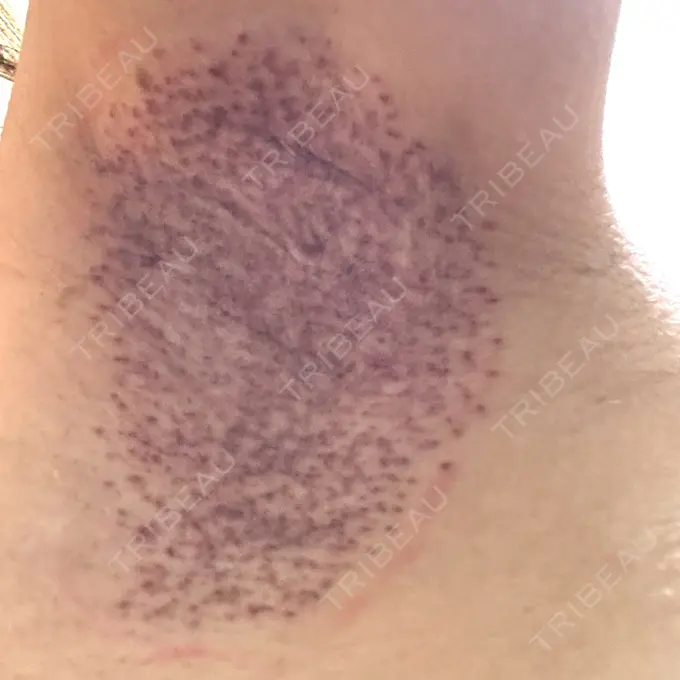 ワキ汗治療（レーザー） アムルーズ美容外科クリニック 大阪院 AFTER メイン用