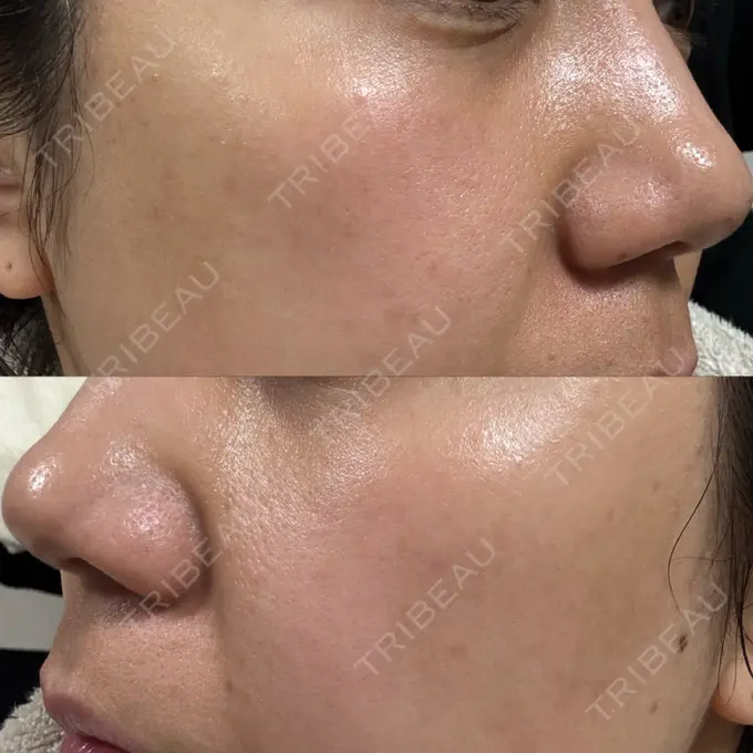 ポテンツァ ルラ美容クリニック 高田馬場院 DAY 12 メイン用