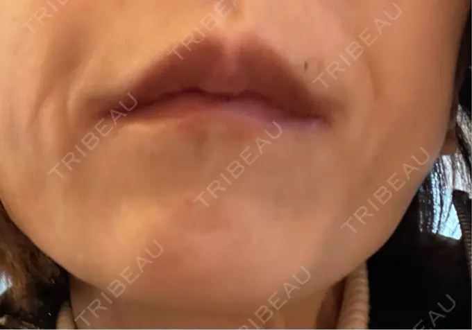 ボトックス（あご） TCB東京中央美容外科 神戸院 DAY 10 メイン用