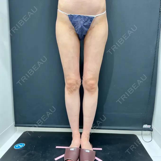 脂肪吸引（脚） / 豊胸（脂肪注入） 湘南美容クリニック 吉祥寺院 DAY 0 メイン用