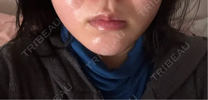 ボトックス（エラ・小顔） / その他（輪郭） ルラ美容クリニック 名古屋栄院 / ルラスキンクリニック 名古屋栄院 DAY 3 メイン用