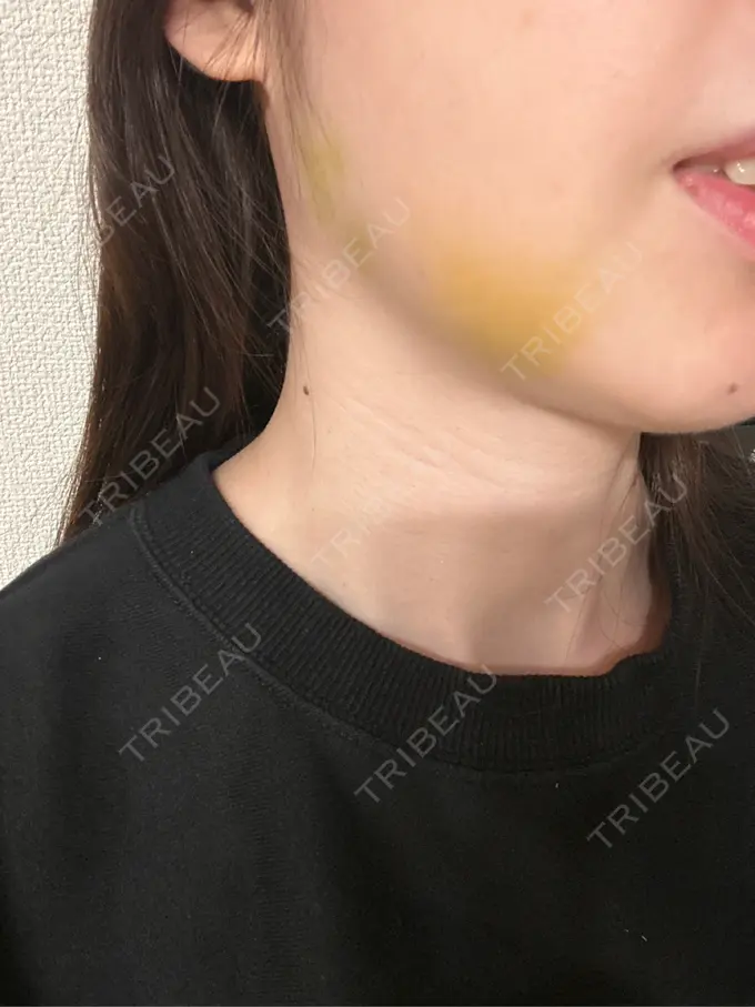 バッカルファット除去 / ボトックス（エラ・小顔） WOM CLINIC GINZA （ワム クリニック ギンザ） DAY 6 メイン用