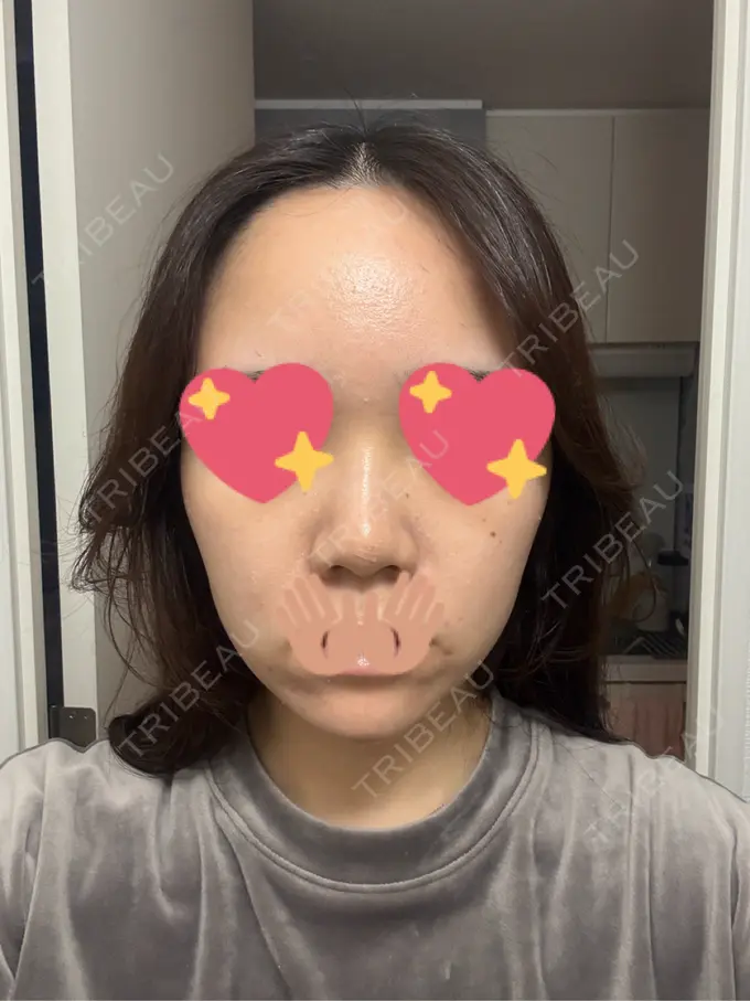 ヒアルロン酸注入（鼻） / ヒアルロン酸注入（あご） HAAB BEAUTY CLINIC 名古屋院 DAY 0 メイン用