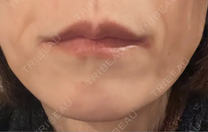 ボトックス（あご） TCB東京中央美容外科 神戸院 AFTER メイン用