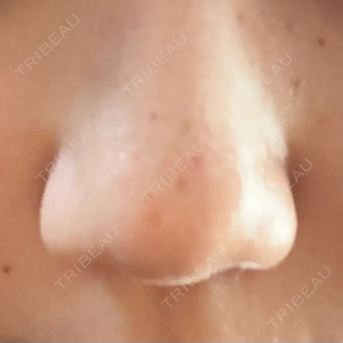 その他（肌） 千里中央花ふさ皮ふ科 DAY 3 メイン用