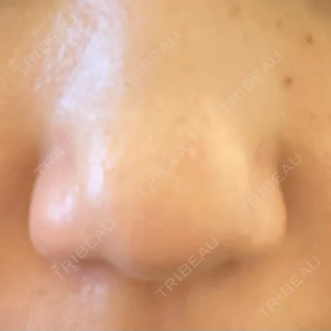 その他（肌） 千里中央花ふさ皮ふ科 DAY 4 メイン用