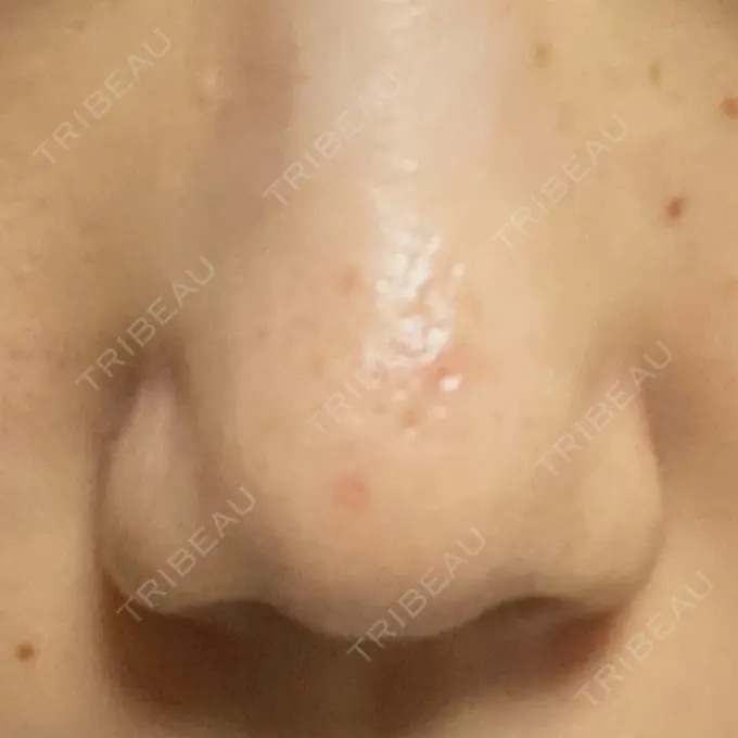 その他（肌） 千里中央花ふさ皮ふ科 DAY 13 メイン用