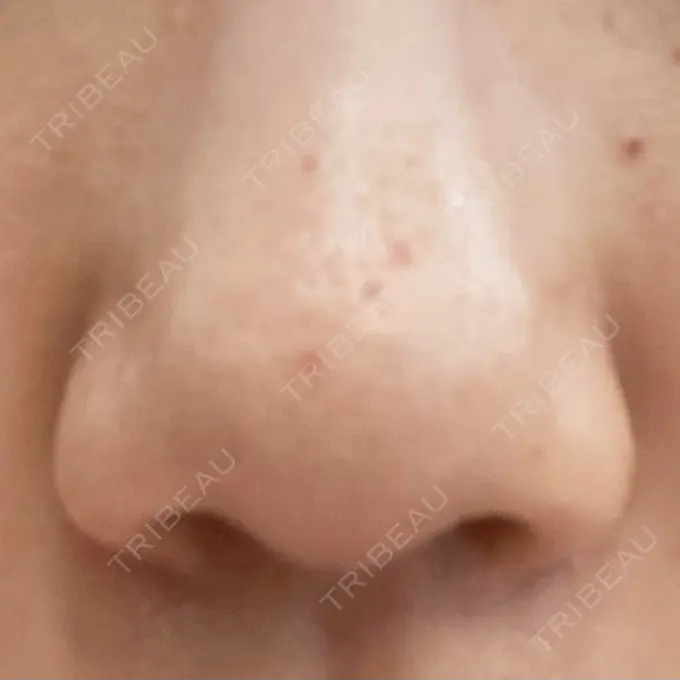 その他（肌） 千里中央花ふさ皮ふ科 DAY 17 メイン用