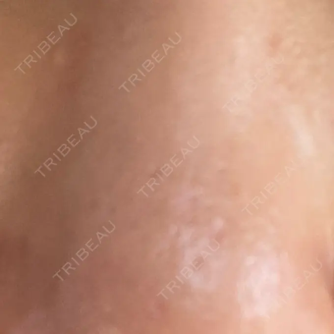 その他（肌） 千里中央花ふさ皮ふ科 DAY 20 メイン用