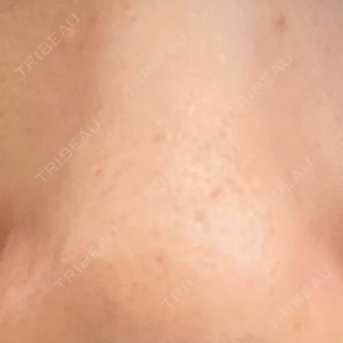 その他（肌） 千里中央花ふさ皮ふ科 DAY 28 メイン用