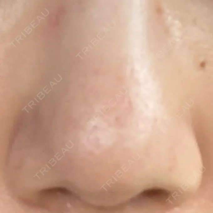 その他（肌） 千里中央花ふさ皮ふ科 DAY 30 メイン用