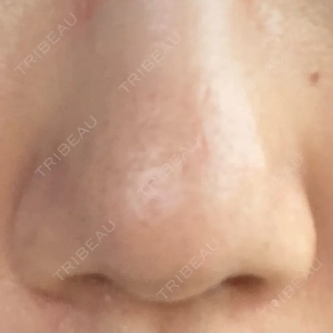 その他（肌） 千里中央花ふさ皮ふ科 DAY 25 メイン用