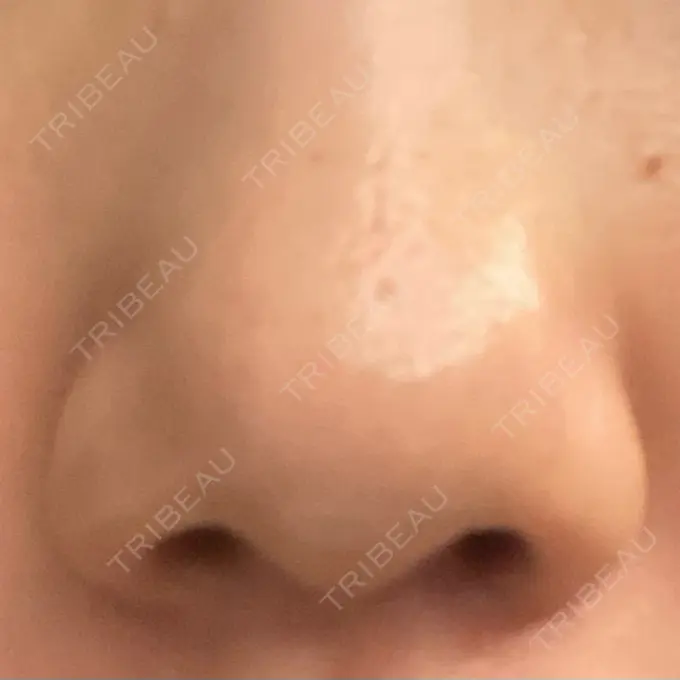 その他（肌） 千里中央花ふさ皮ふ科 AFTER メイン用