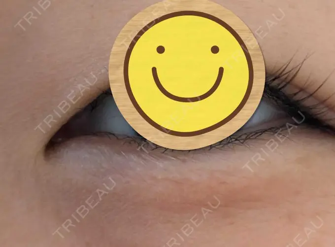 ヒアルロン酸注入（涙袋） / ボトックス（額） ルヴィクリニック イオンドーム前院 DAY 0 メイン用