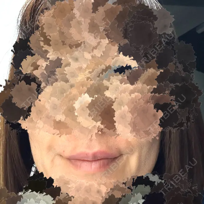 プラセンタ注射 / 美容点滴・美容注射（疲労回復） / その他（口元） TCB東京中央美容外科 久留米院 AFTER メイン用