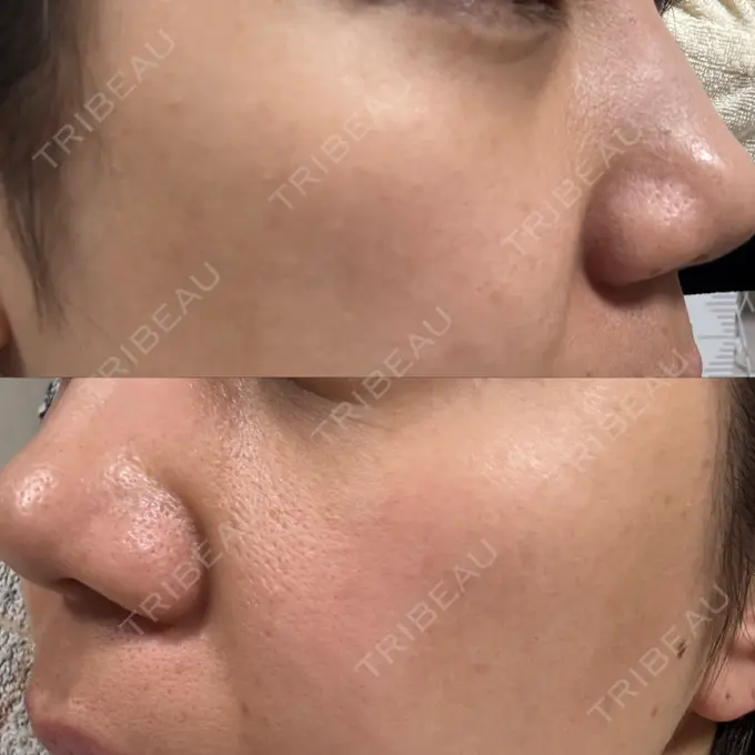 ポテンツァ ルラ美容クリニック 高田馬場院 DAY 14 メイン用