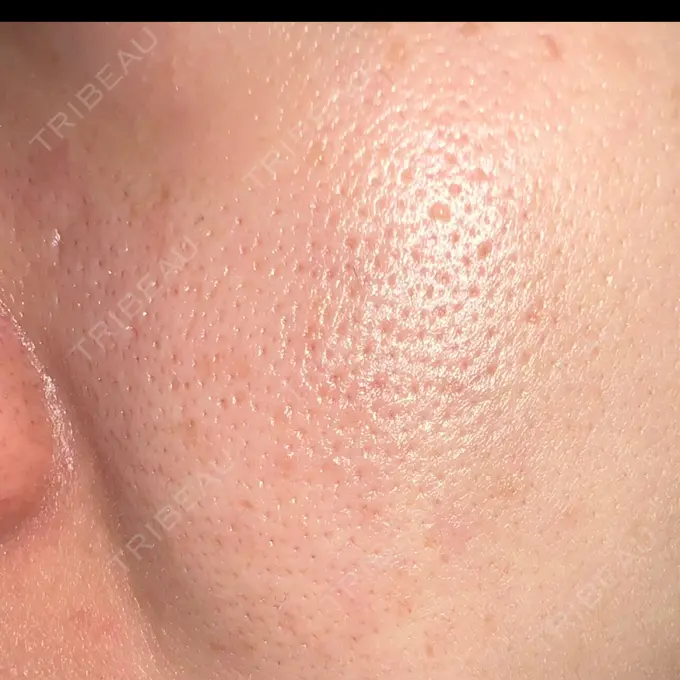 ポテンツァ REDLINE CLINIC DAY 7 メイン用