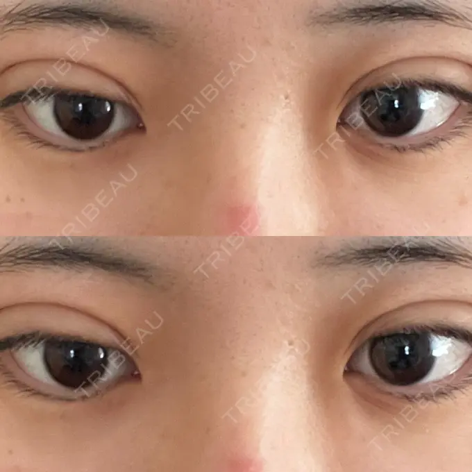 二重埋没 / 糸リフト / バッカルファット除去 / ジョールファット除去 / ボトックス（エラ・小顔） / その他（目元） / その他（輪郭） MEMOTO CLINIC 名古屋 AFTER メイン用