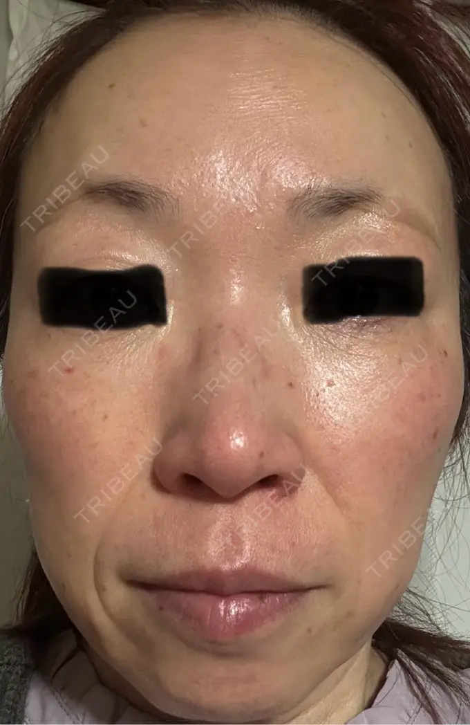 ピーリング（ハリ・ツヤ） 椿クリニック 名古屋院 DAY 16 メイン用