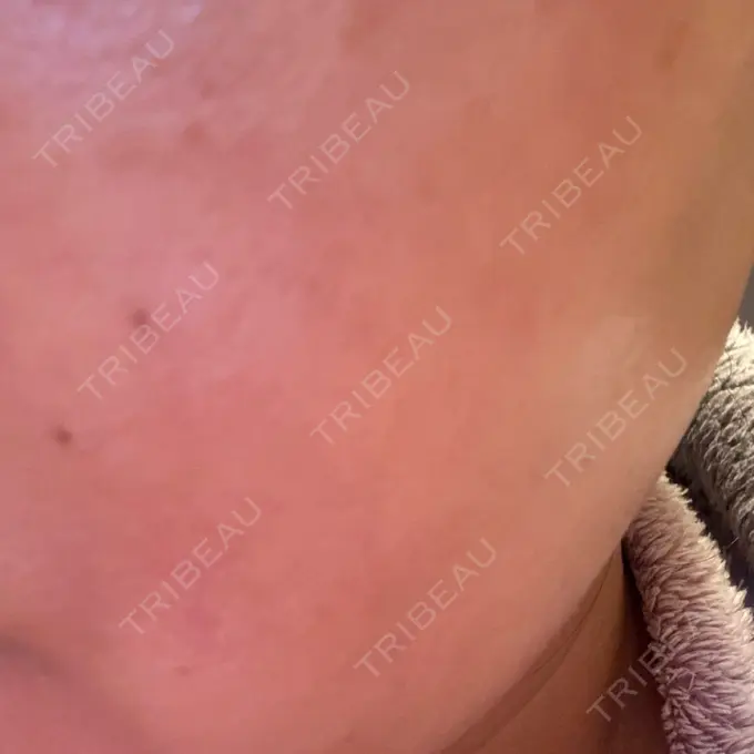 ルメッカ ルラ美容クリニック 池袋院 DAY 0 メイン用