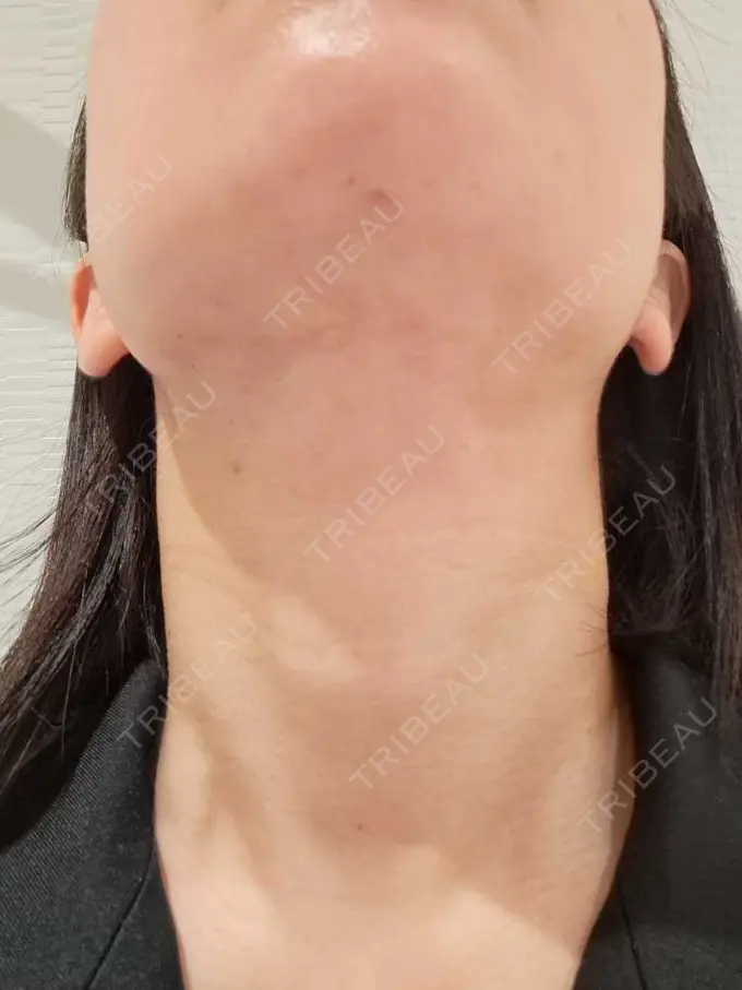 クマ治療 / 脂肪吸引（顔） / 脂肪吸引（二の腕） / 脂肪吸引（肩） / 脂肪注入（目の下） Mods Clinic（モッズクリニック） 名古屋院 DAY 29 メイン用