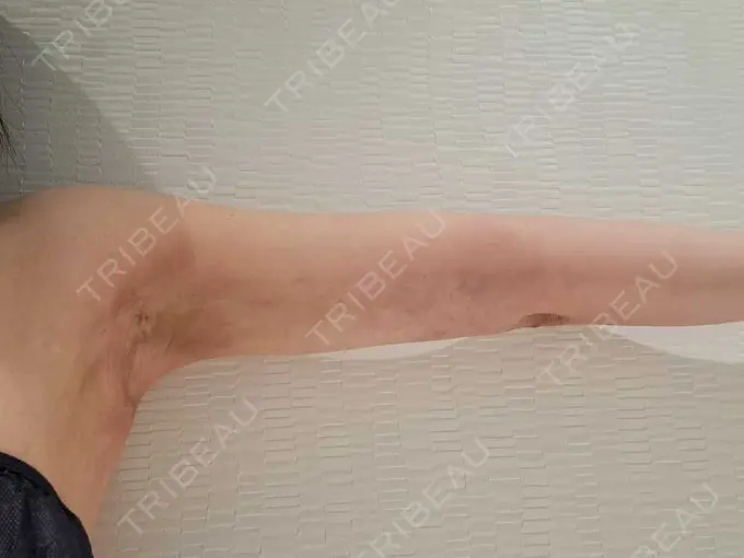 クマ治療 / 脂肪吸引（顔） / 脂肪吸引（二の腕） / 脂肪吸引（肩） / 脂肪注入（目の下） Mods Clinic（モッズクリニック） 名古屋院 DAY 29 メイン用