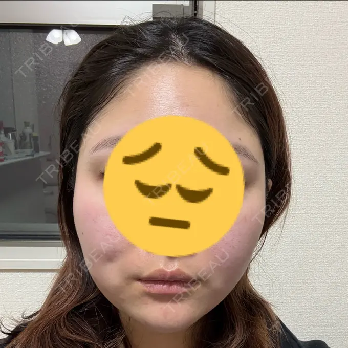 糸リフト / ボトックス（エラ・小顔） TCB東京中央美容外科 千葉駅前院 DAY 17 メイン用