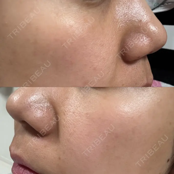 ポテンツァ ルラ美容クリニック 高田馬場院 DAY 15 メイン用