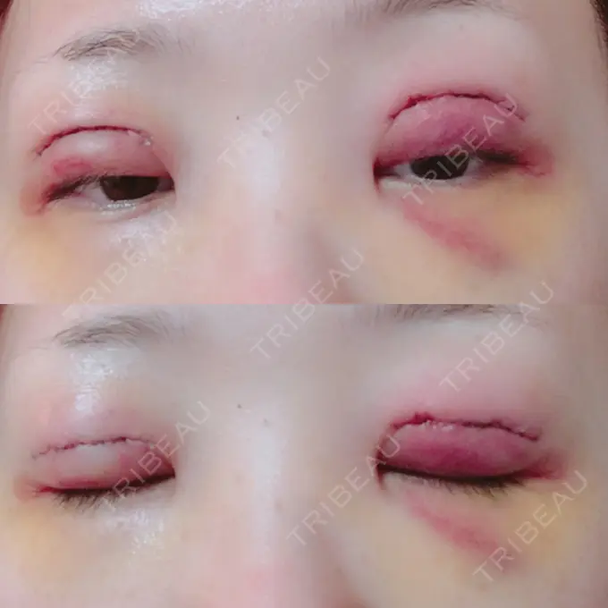 二重切開 城本クリニック 豊橋院 DAY 5 メイン用