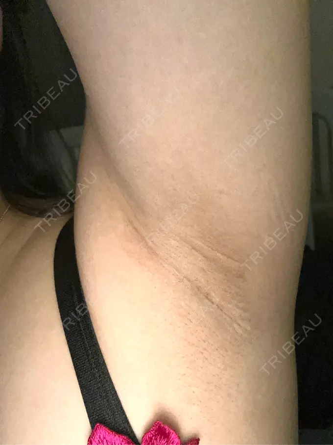 豊胸（シリコンバッグ） ジョウクリニック 那覇院 DAY 611 メイン用