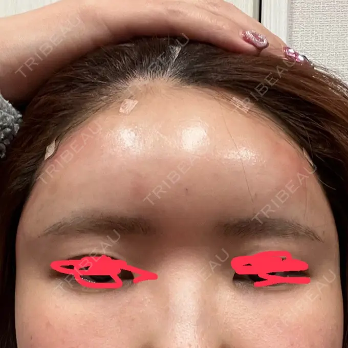 脂肪注入（額） GRACIA clinic 【グラシアクリニック】 DAY 0 メイン用