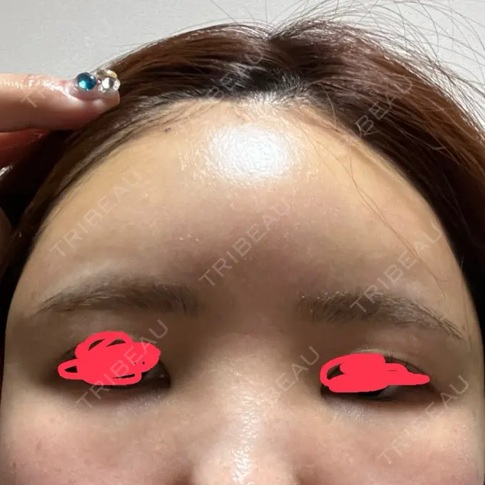 脂肪注入（額） GRACIA clinic 【グラシアクリニック】 DAY 2 メイン用