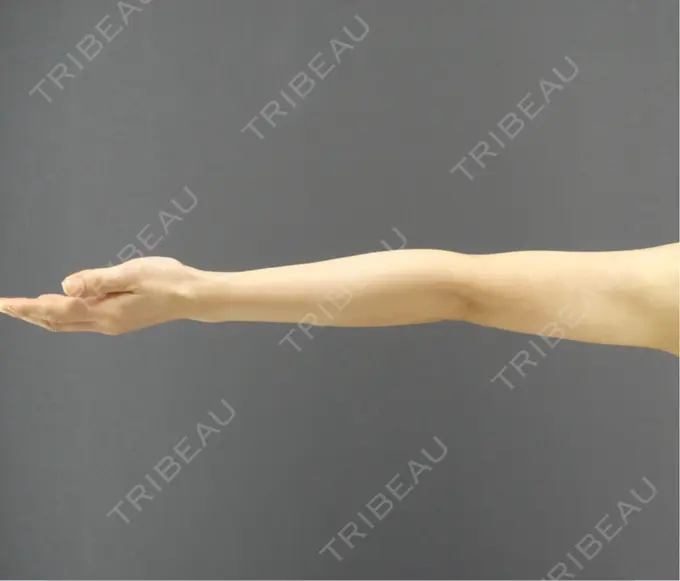 脂肪吸引（二の腕） / 脂肪吸引（肩） GRACIA clinic 【グラシアクリニック】 DAY 109 メイン用