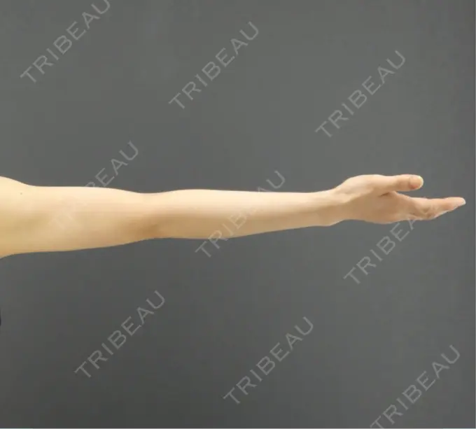 脂肪吸引（二の腕） / 脂肪吸引（肩） GRACIA clinic 【グラシアクリニック】 AFTER メイン用