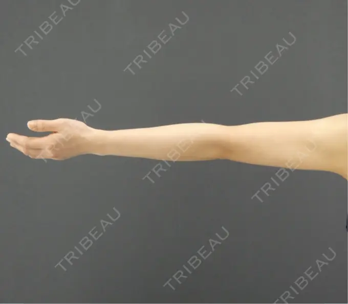 脂肪吸引（二の腕） / 脂肪吸引（肩） GRACIA clinic 【グラシアクリニック】 DAY 200 メイン用