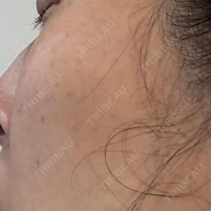 イオン導入 / ルメッカ ルラ美容クリニック 名古屋本院 DAY 15 メイン用