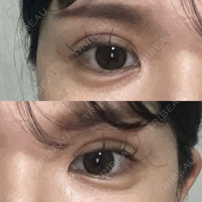 二重埋没 / 糸リフト / ヒアルロン酸注入（涙袋） / ボトックス（エラ・小顔） / ヒアルロン酸注入（頬） 東京シンデレラ美容外科 池袋院 DAY 8 メイン用