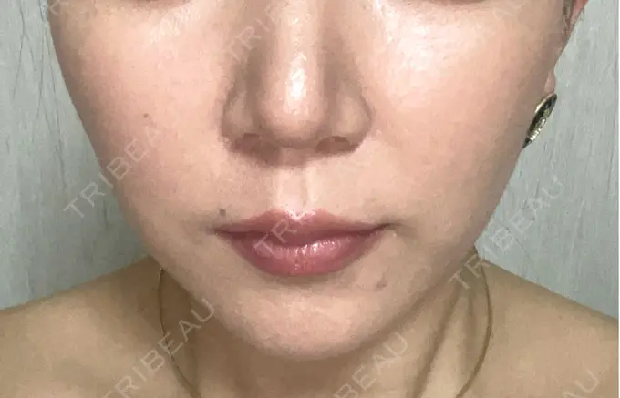 二重埋没 / 糸リフト / ヒアルロン酸注入（涙袋） / ボトックス（エラ・小顔） / ヒアルロン酸注入（頬） 東京シンデレラ美容外科 池袋院 DAY 8 メイン用