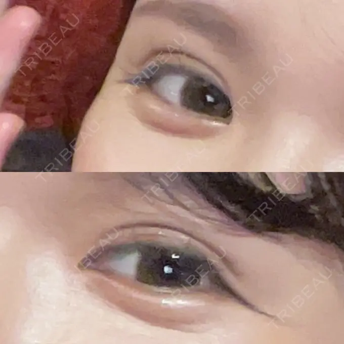 二重埋没 / 糸リフト / ヒアルロン酸注入（涙袋） / ボトックス（エラ・小顔） / ヒアルロン酸注入（頬） 東京シンデレラ美容外科 池袋院 AFTER メイン用