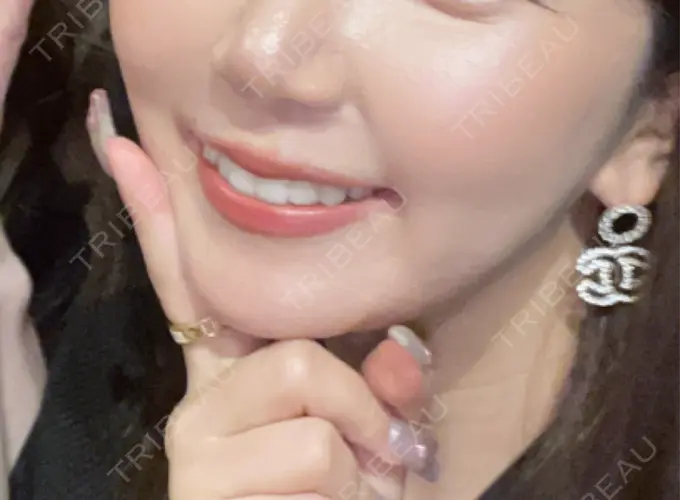 二重埋没 / 糸リフト / ヒアルロン酸注入（涙袋） / ボトックス（エラ・小顔） / ヒアルロン酸注入（頬） 東京シンデレラ美容外科 池袋院 DAY 27 メイン用