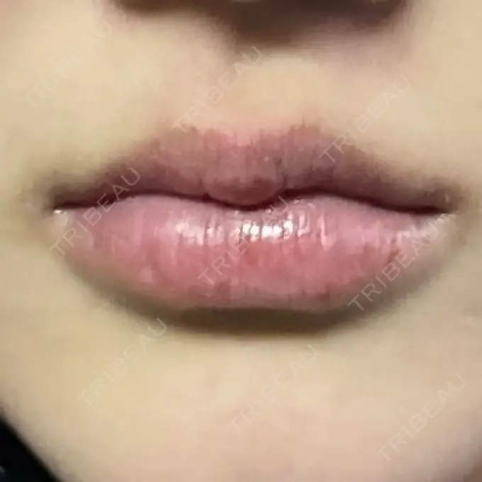 ヒアルロン酸注入（唇） / ボトックス（口角） ルラ美容クリニック 高田馬場院 AFTER メイン用